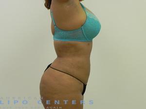 americanlipocenters_161.jpg